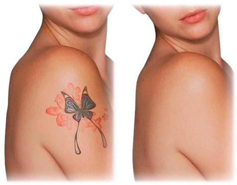 Endolifting de papada